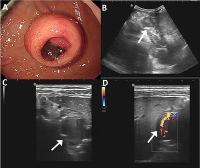 Gastroblastoma in a 5-year-old child: a case report and literature review